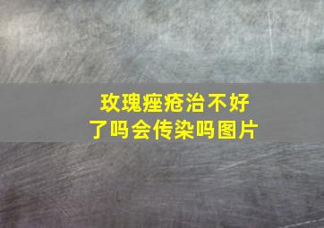 玫瑰痤疮治不好了吗会传染吗图片