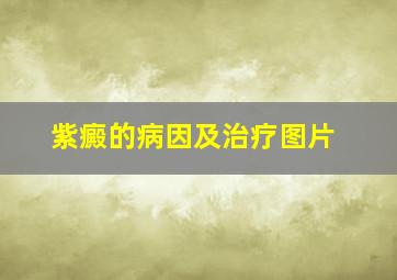 紫癜的病因及治疗图片